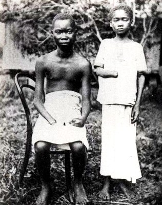 Verstümmelte Jugendliche im Kongo ca. 1904 IMG
